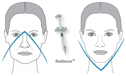 корректировка овала лица (скулы) - радиесс