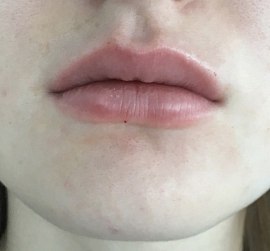 Коррекция формы губ