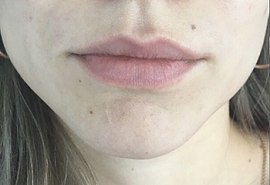 Носогубка и губы