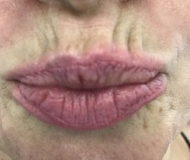 Коррекция возрастных губ