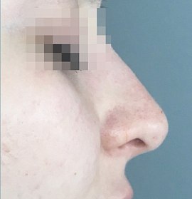 Коррекция спинки носа