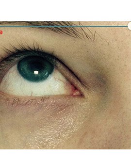 Коррекция носослезной борозды, фото до и после
