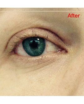 Коррекция носослезной борозды, фото до и после
